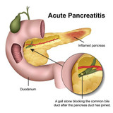 Pancreatitis in Pets