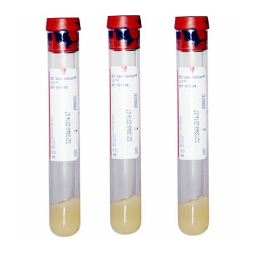 BD Vacutainer® SST™ Venous Blood Collection Tube Serum Tube Clot Activator / Separator Gel Additive 16 X 100 mm 8.5 mL Red / Gray Mottled Conventional Closure Plastic Tube