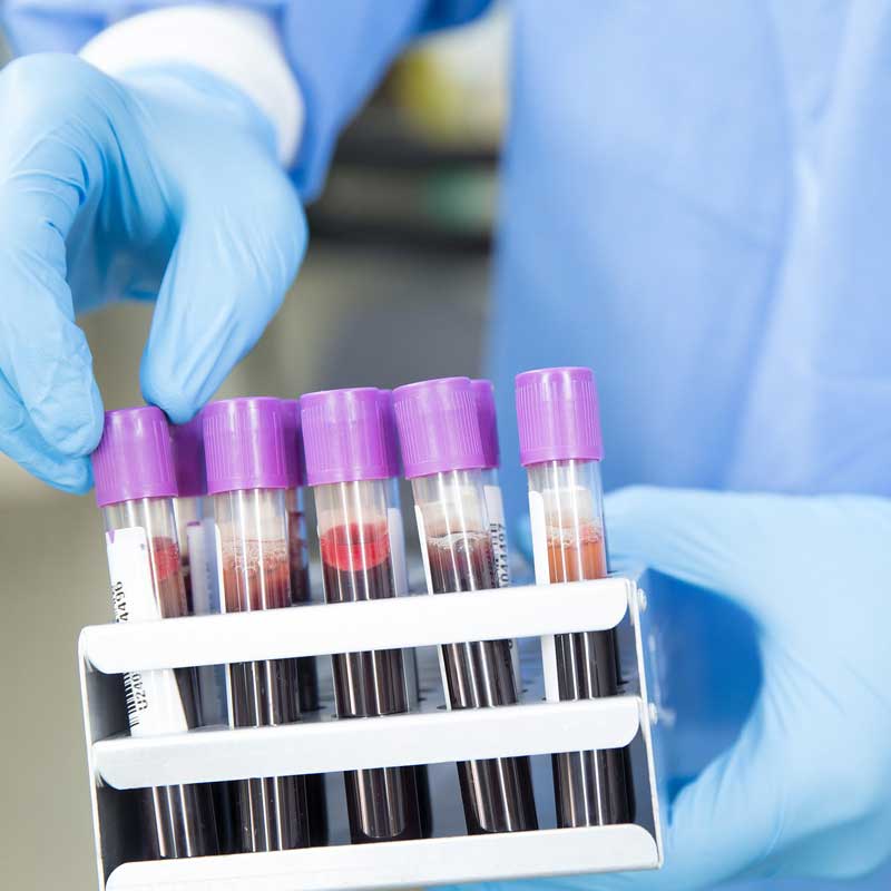 Detecting the Presence and Orientation of Caps of Blood Test-Tubes by Means of Photoelectric Analog Reflex Sensors