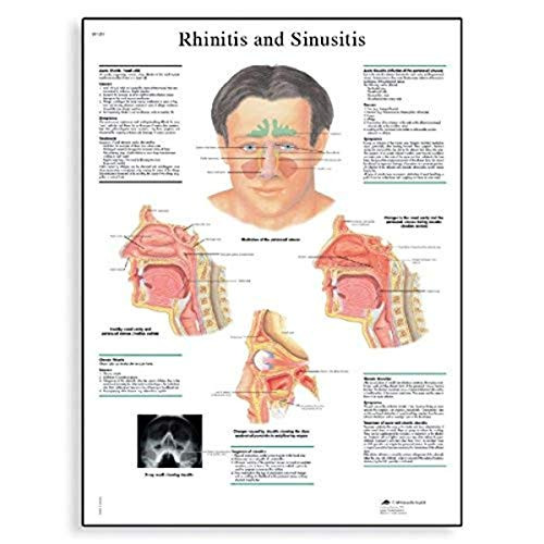 3B Scientific VR2251L Glossy UV Resistant Laminated Paper Rhinite Et Sinusite Anatomical Chart Rhinitis and Sinusitis Anatomical Chart French Poster Size 20 Width x 26 Height