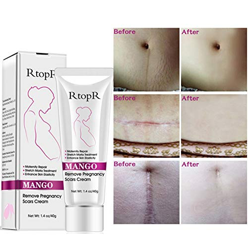 5pcs Scars Removal Cream  Mango Remove Pregnancy Scars Cream Stretches Marks Treatment Maternity Repair Firming Skin