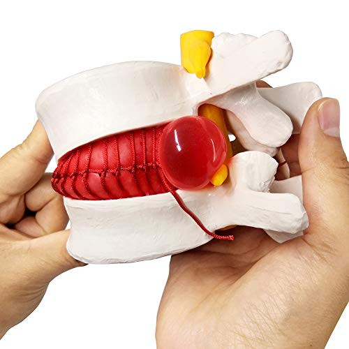 Human Herniated Disc Model Anatomical Herniated Lumbar Vertebrae Disc Prolapse Model for Medical Teaching Learning Kids Learning Education Display Toolning Kids Learning Education Display Tool