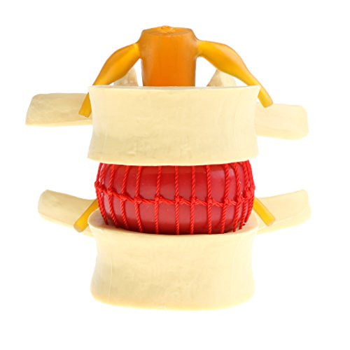 menolana Anatomical Human Spine Lumbar Disc Protrusion Model Display Magnification 2X