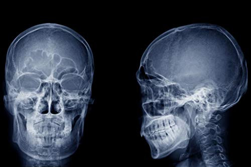 Human Skull Xray Image Front and Side Lateral View Skeleton Anatomy Medical Photo Cool Wall Decor Art Print Poster 24x36