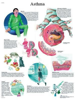 VR1328UU - Asthma Chart - 3B Scientific Asthma Chart - Each