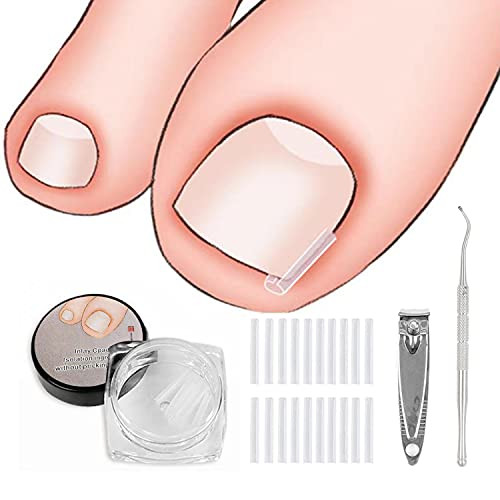 Ingrown Toenail Correction Tool, Include 60 Pieces Ingrown Toenail Corrector Strips, Ingrown Toenail Lifter And Nail Clipper, Professional Thick Paronychia Ingrown Toenail Correction Pedicure Tool Set