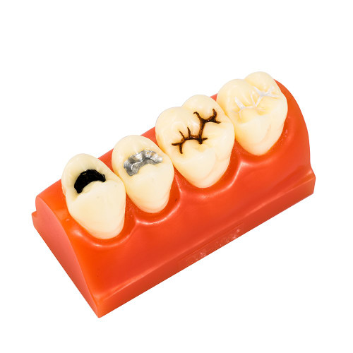 Easyinsmile Dental Pathology Teeth Study Teaching Model Sealantant Demonstration Tooth Model for Patient Education
