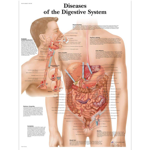 3B Scientific VR1431UU Glossy Paper Diseases of The Digestive System Anatomical Chart, Poster Size 20" Width x 26" Height 3B Scientific VR1431UU Glossy Paper Diseases of The Digestive System Anatomical Chart, Poster Size 20" Width x 26" Height