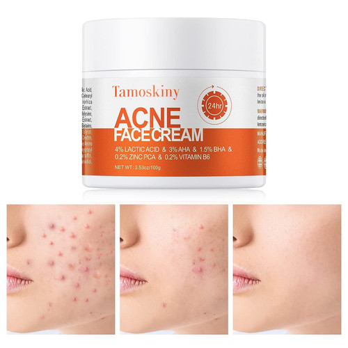 Acne Face Cream, Salicylic Acid Cystic Acne Treatment For Face, Back But Acne Treatment Cream, Acne Spot Treatment for Face and Body, Acne Clearing Cream for Teens & Adults, Acne Moisturizer, 3.53 OZ