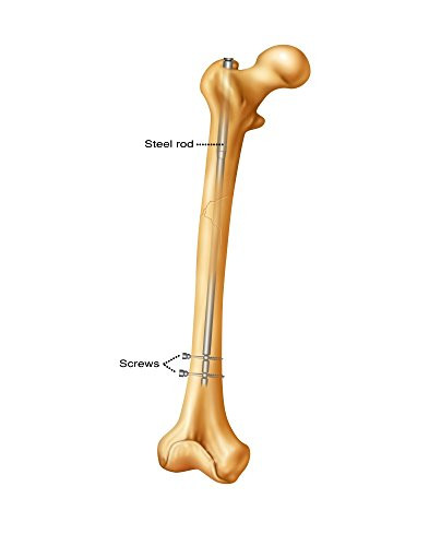 Femur Fracture Repair Poster Print by Gwen ShockeyScience Source 18 x 24