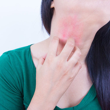 Eczema Causes and Treatment