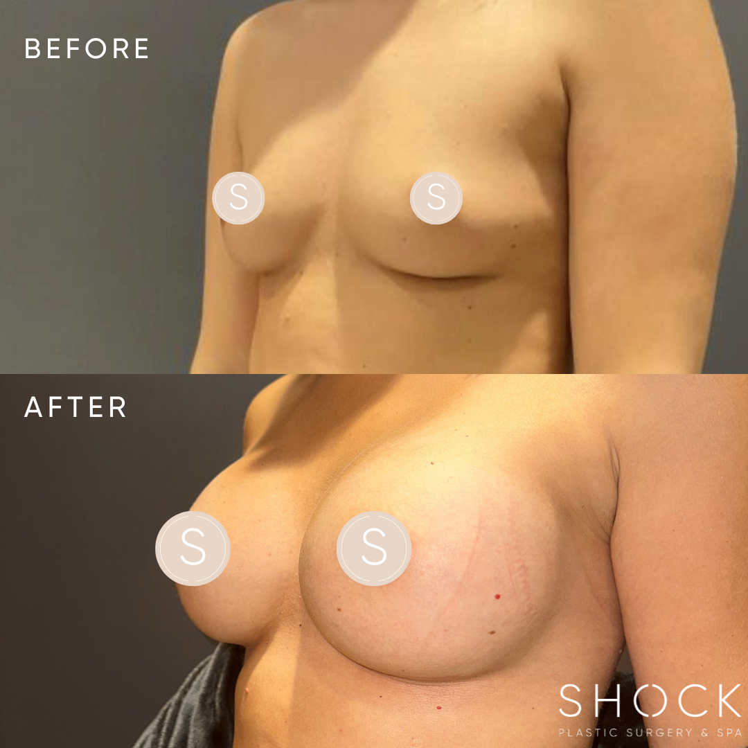 breast augmentation in Columbia MO