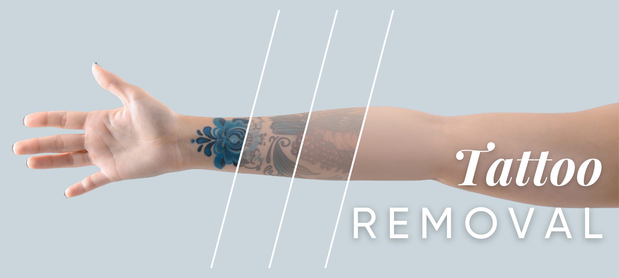 Tattoo Removal Procedures in Columbia, MO