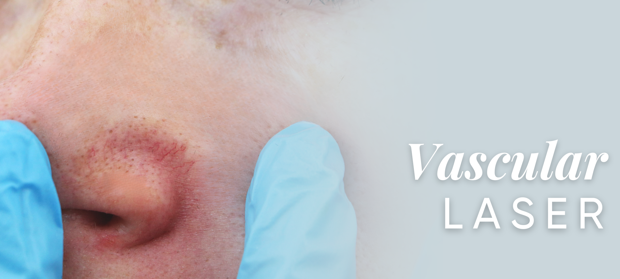 Vascular Lesion Removal Procedures in Columbia, MO