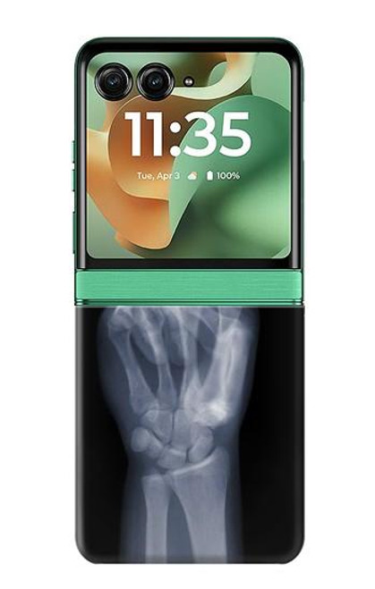 S3101 X-ray Peace Sign Fingers Case For Motorola Razr 60, Razr 2025