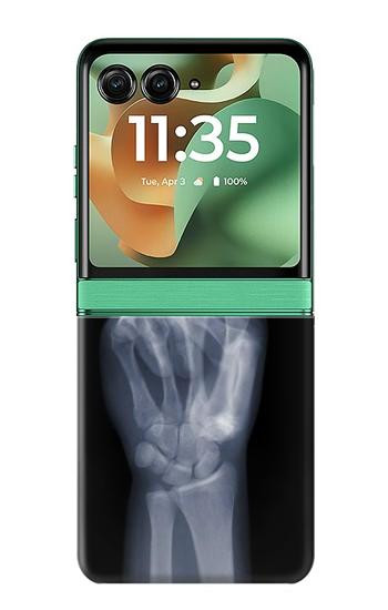 S3101 X-ray Peace Sign Fingers Case For Motorola Razr 70+,60+, Razr+ (2026, 2025, 2024)