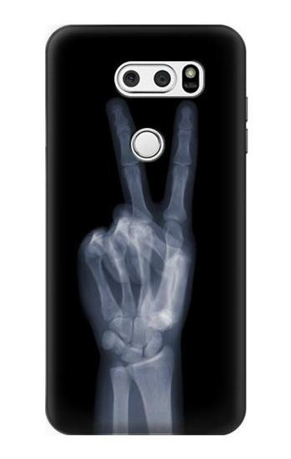 S3101 X-ray Peace Sign Fingers Case For LG V30, LG V30 Plus, LG V30S ThinQ, LG V35, LG V35 ThinQ