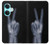 S3101 X-ray Peace Sign Fingers Case For OnePlus Nord CE3