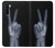 S3101 X-ray Peace Sign Fingers Case For OnePlus Nord