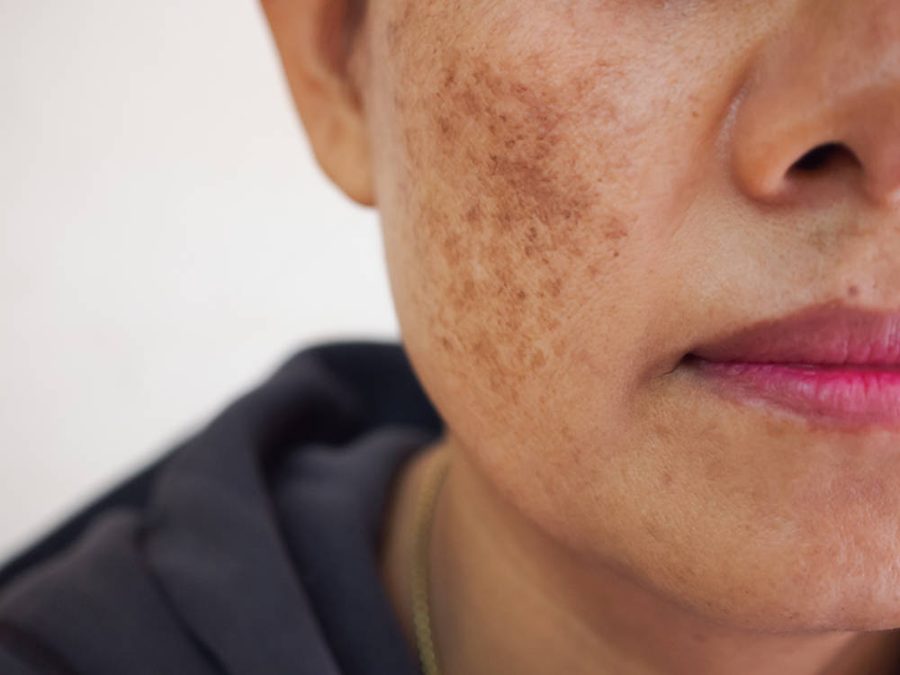 Darn dark spots!  What causes hyperpigmentation on your face and body 