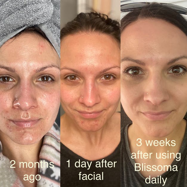 Results after 3 weeks with Blissoma skincare Pure Sensitive Care Complex and Smooth A+ Correcting Serum for acne and sensitive skin