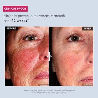 Before-and-after close-up of the eye and cheek area showing visibly smoother skin, reduced fine lines and wrinkles, and a more even, rejuvenated appearance after 12 weeks of use.