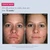 Before-and-after front-facing images showing visibly clearer skin with reduced breakouts and fewer blemishes after 12 weeks of use.