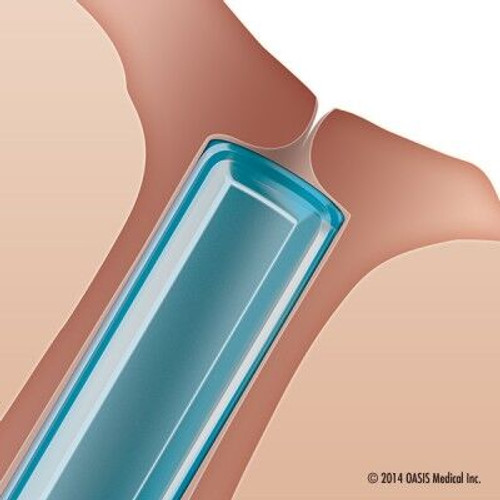 OASIS SOFT PLUG® Extended Duration Punctal Plugs - Box of 20 | MH Eye Care Product