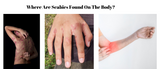 Natural Remedies for Scabies: Can Herbs Help Get Rid of the Itch?