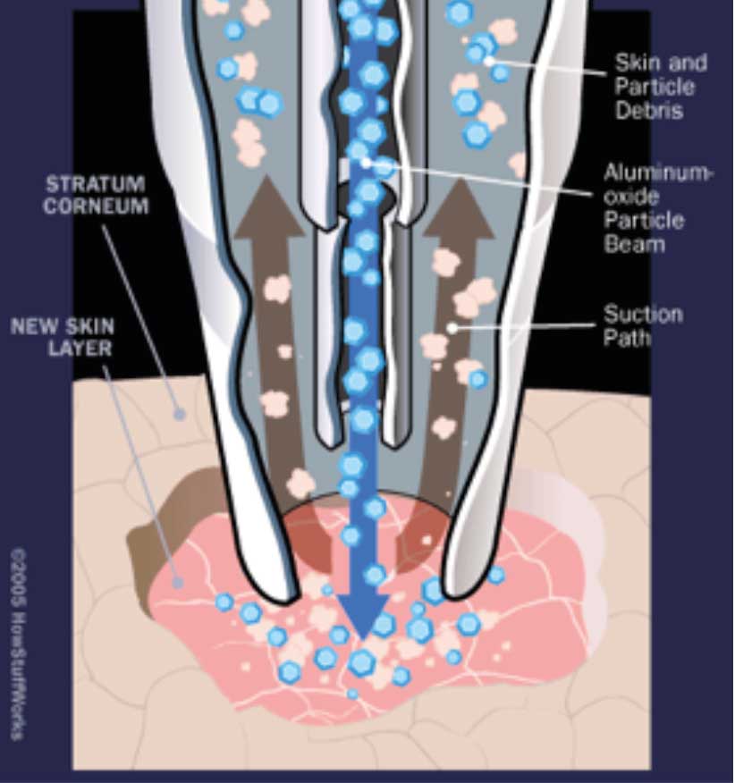 microdermabrasion-the-science-and-art-.jpg