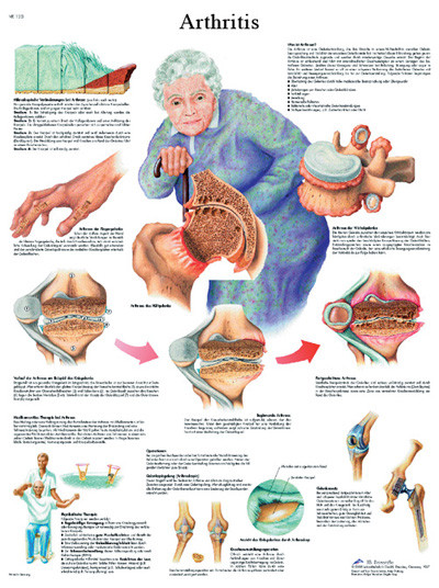 3B Scientific Anatomical Chart - arthritis, laminated