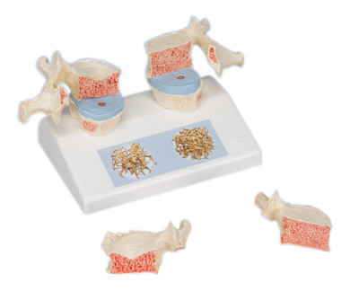 3B Scientific 3B Scientific Anatomical Model - osteoporosis model - Includes 3B Smart Anatomy