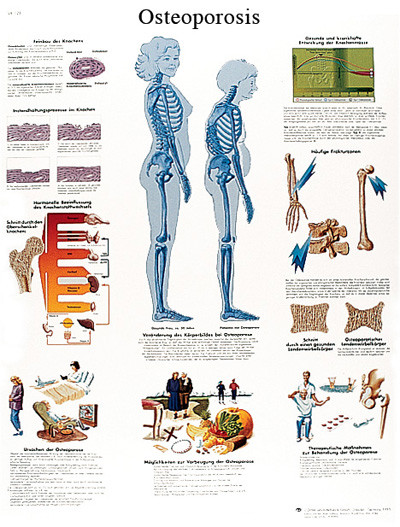 3B Scientific Anatomical Chart - osteoporosis, laminated