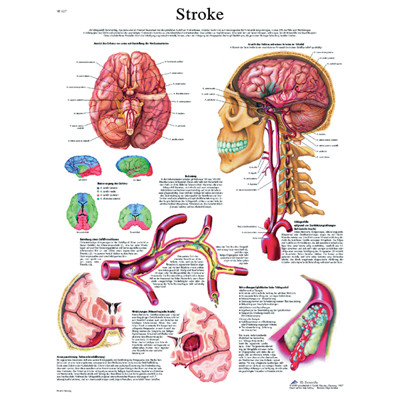 3B Scientific Anatomical Chart - stroke chart, laminated