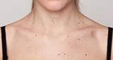 The ABCDEs of Getting to Know Your Moles The ABCDEs of Getting to Know Your Moles