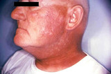 What is Radiation Dermatitis? What is Radiation Dermatitis?