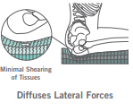 Supracor Diffuses Lateral Forces