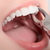 Temp Teeth