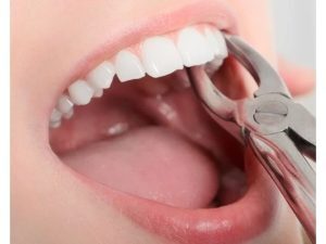 Immediate Temporary Tooth