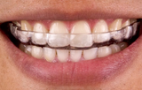 Is Covid a Cause of Clenching and Grinding Teeth (Needing a Nightguard?)