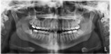 How Often Should Dental X-rays be Taken?