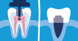 Deciding Between Root Canal and Implant