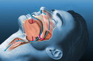 Can Dentists Treat  Obstructive Sleep Apnea?