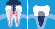 Deciding Between Root Canal and Implant