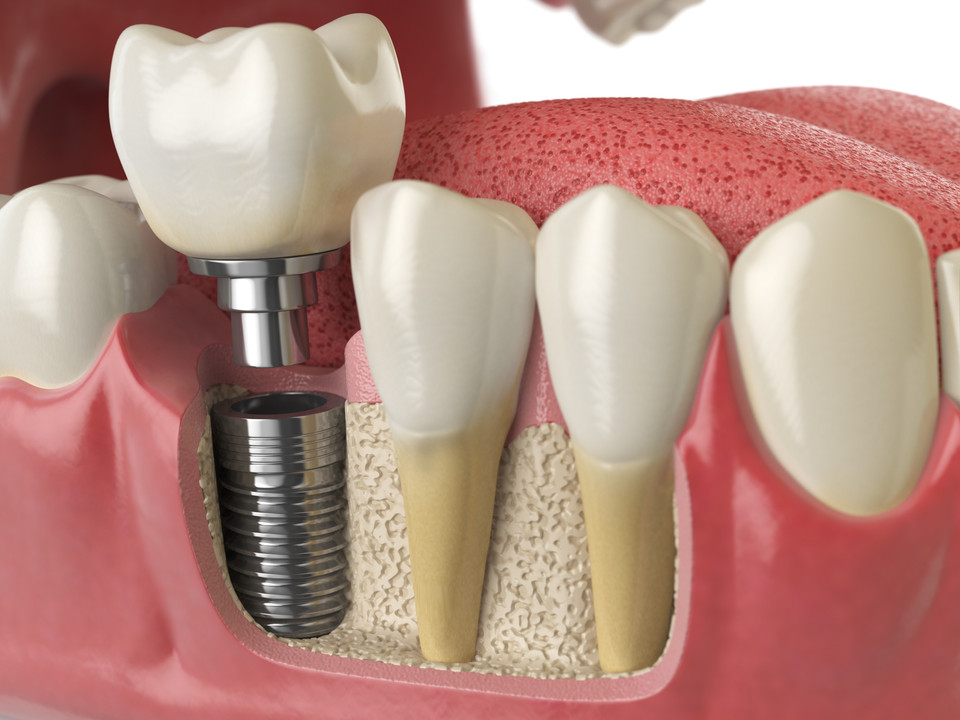 Contraindications to Dental Implant Placement Dental Didactics CE