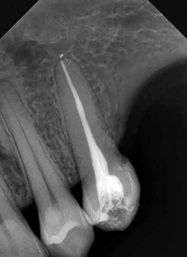 Can Antibiotics Cure a Tooth (Root Canal) Infection? Dental Didactics CE