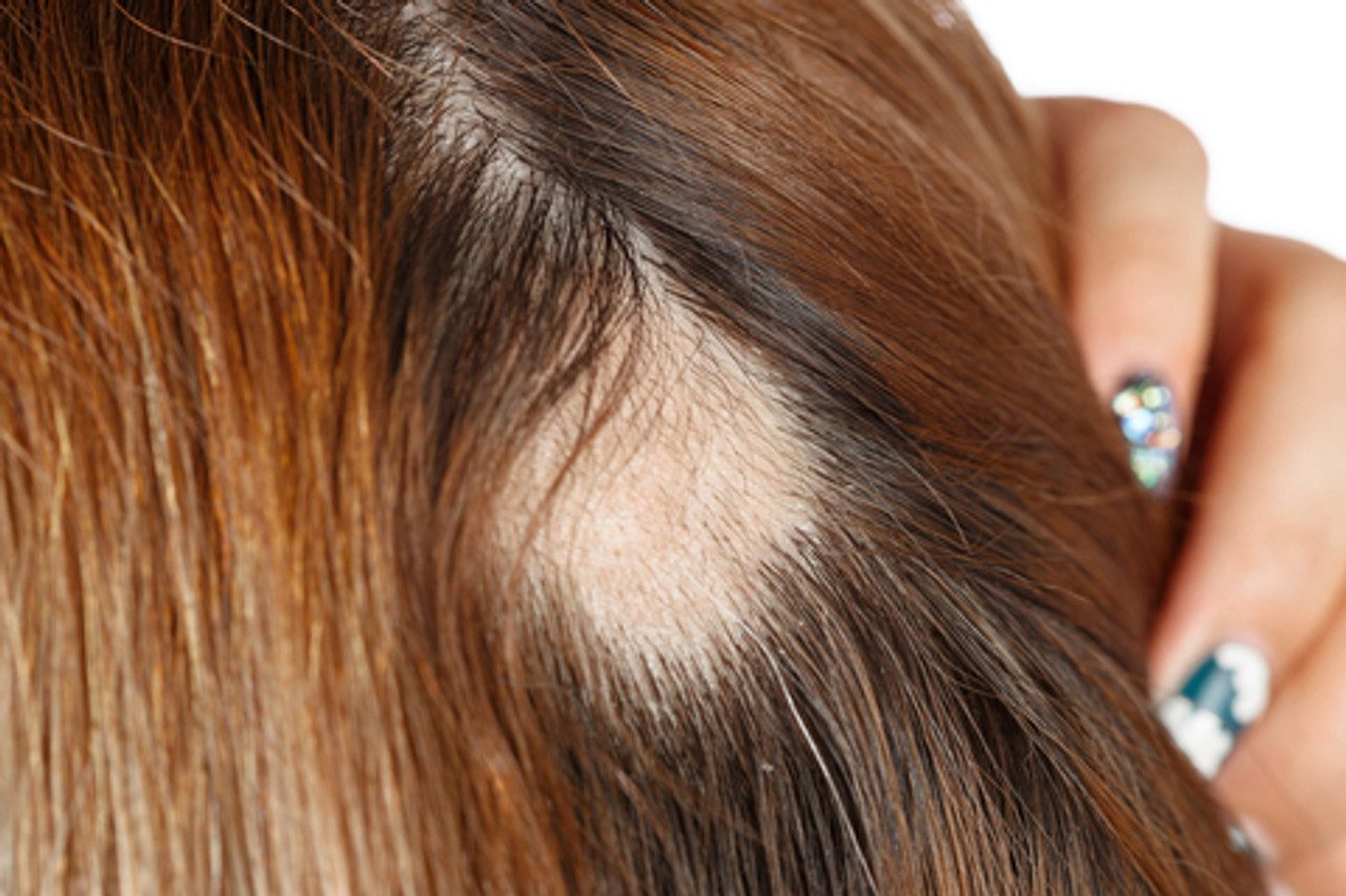 Alopecia Topical Treatment