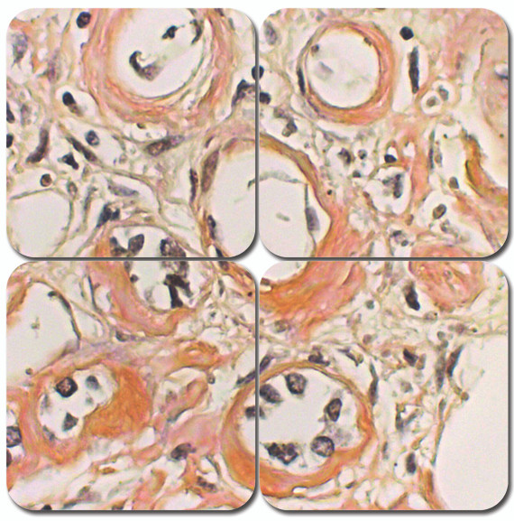 Congo Red Amyloid Stain Kit