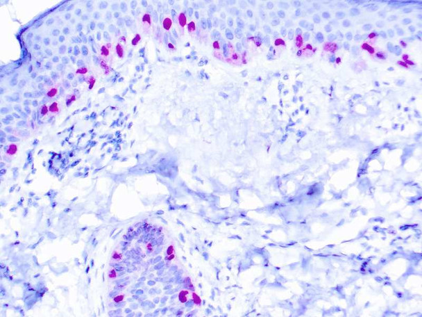 MiTF, Microphthalmia Transcription Factor, Clone D5