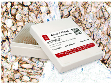Breast Carc. c-erbB-2+ /Pk(25)